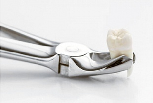 Удаление зубов